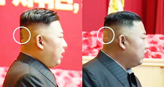 “Me një shenjë të errët në kokë”/ Kim Jong-un, në gjendje jo të mirë shëndetësore?